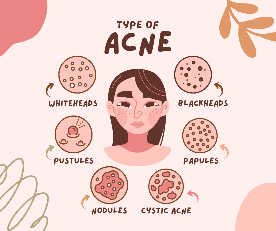 Types of acne on face