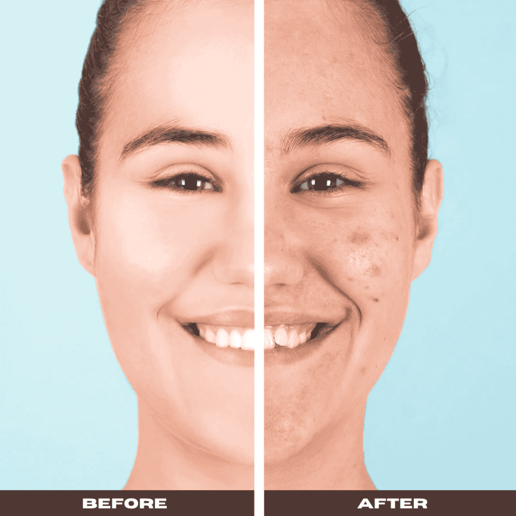 Whiteheads on face results