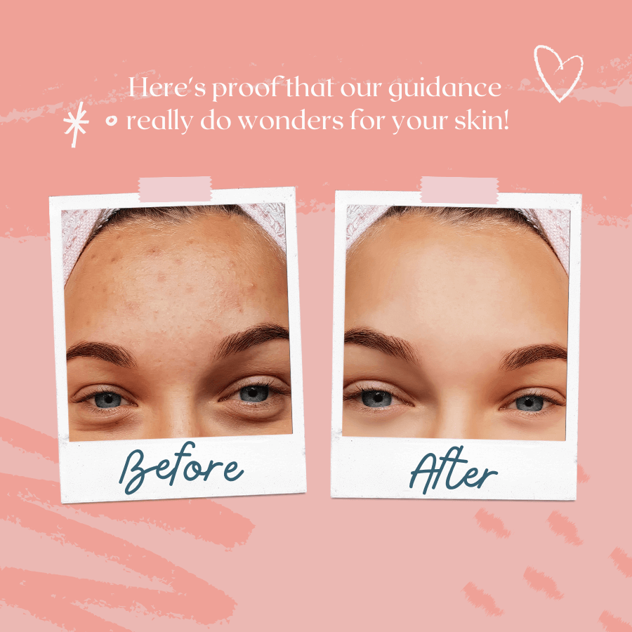 small pimples on forehead