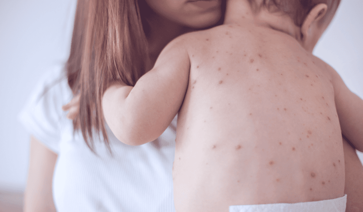 Measles Outbreaks Cases