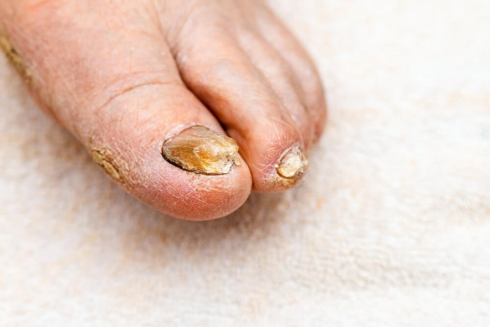 Pitted Nails