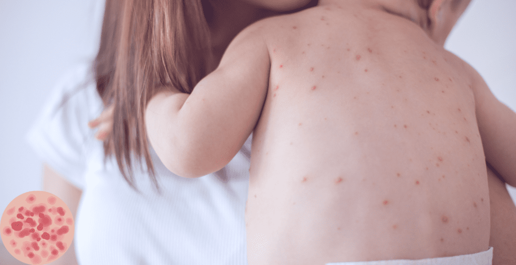 Symptoms of Measles Outbreak in US
