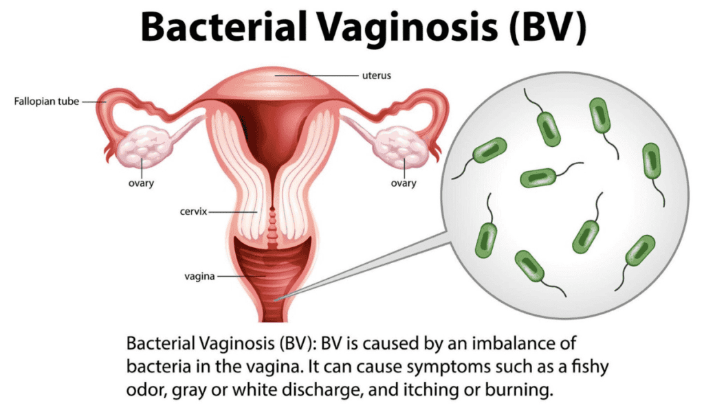 What is BV Bacterial Vaginosis
